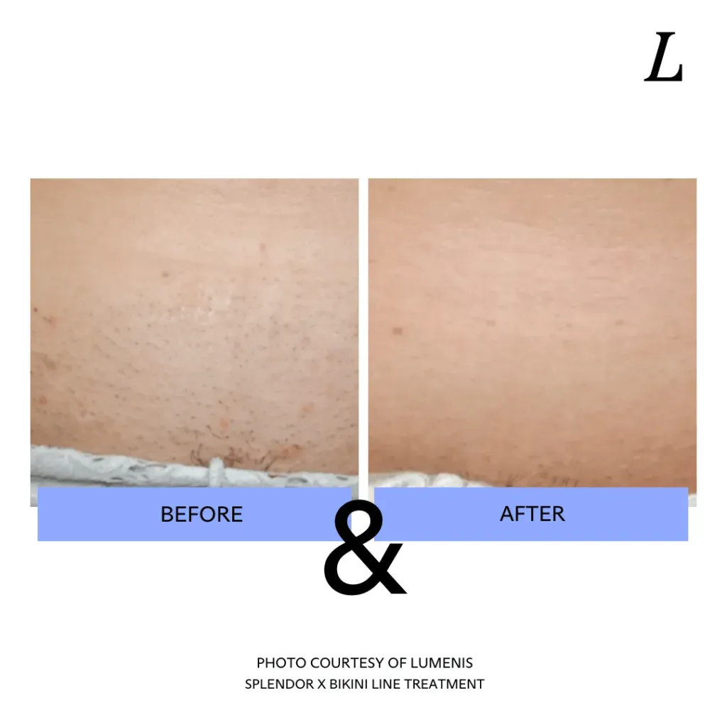 After the Zap: PostCare and Results When Asking What Does Brazilian Laser Hair Removal Include