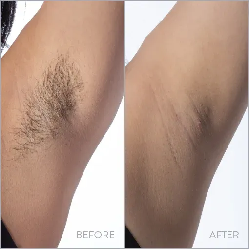 Proven best underarm laser hair removal solutions