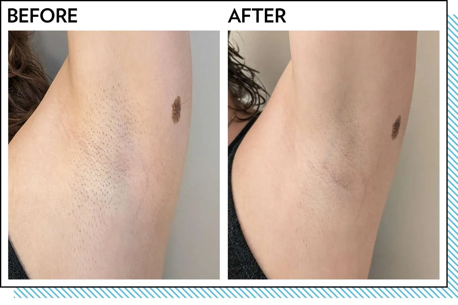 Beyond the Hype: Key Factors in At Home Laser Hair Removal Reviews
