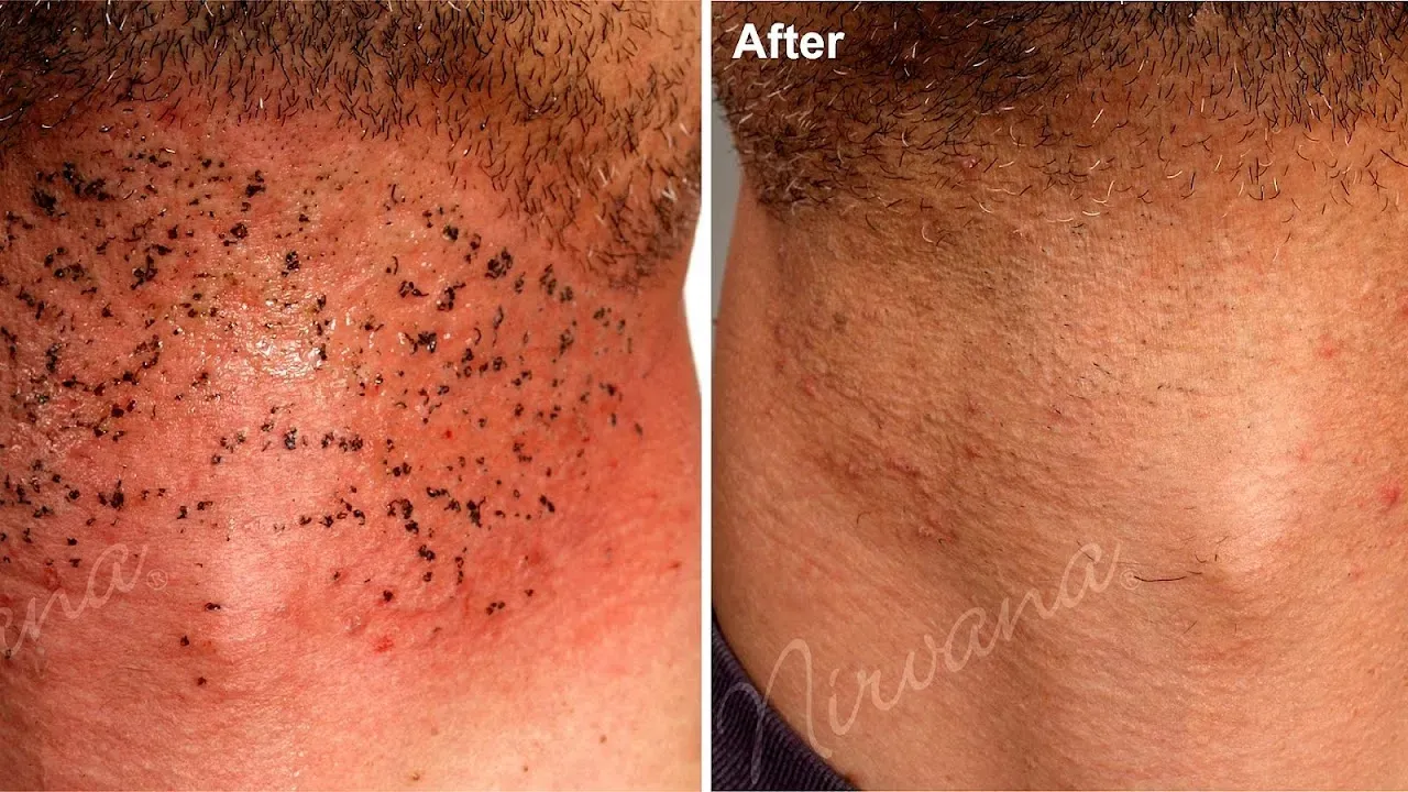 Common Side Effects and Other Brazilian Laser Hair Removal Risks