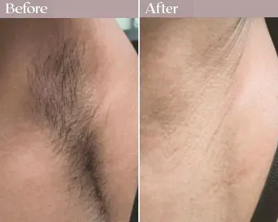 Comparing Options for Best Laser Hair Removal Long Island