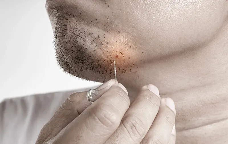 Considering Professional Facial Ingrown Hair Removal Near Me