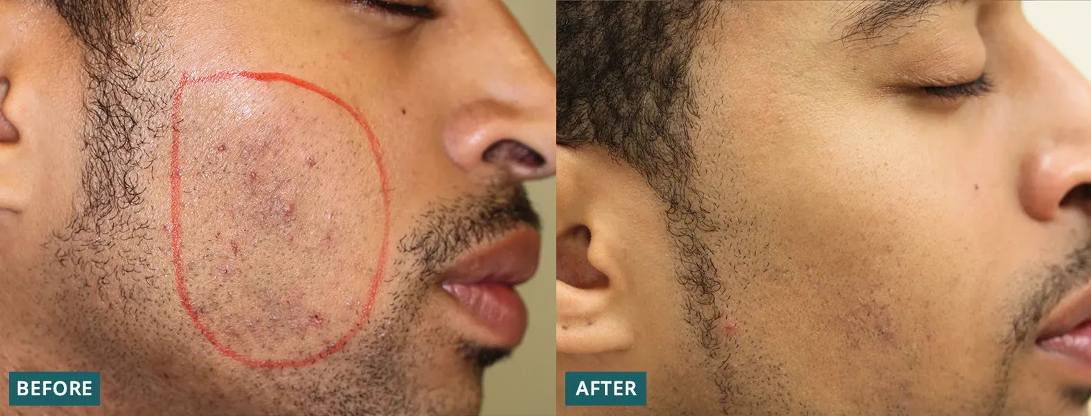 Dealing with Pesky Facial Ingrown Hairs: Why They Happen