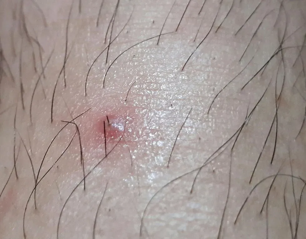 Simple fast ingrown hair removal for smooth skin