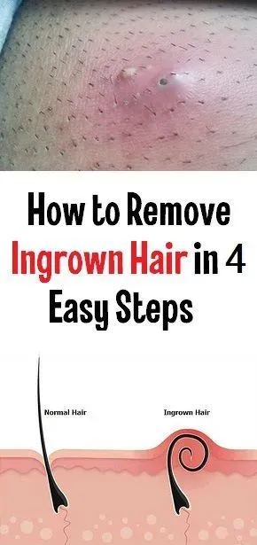 Quick guide how to remove a ingrown hair at home