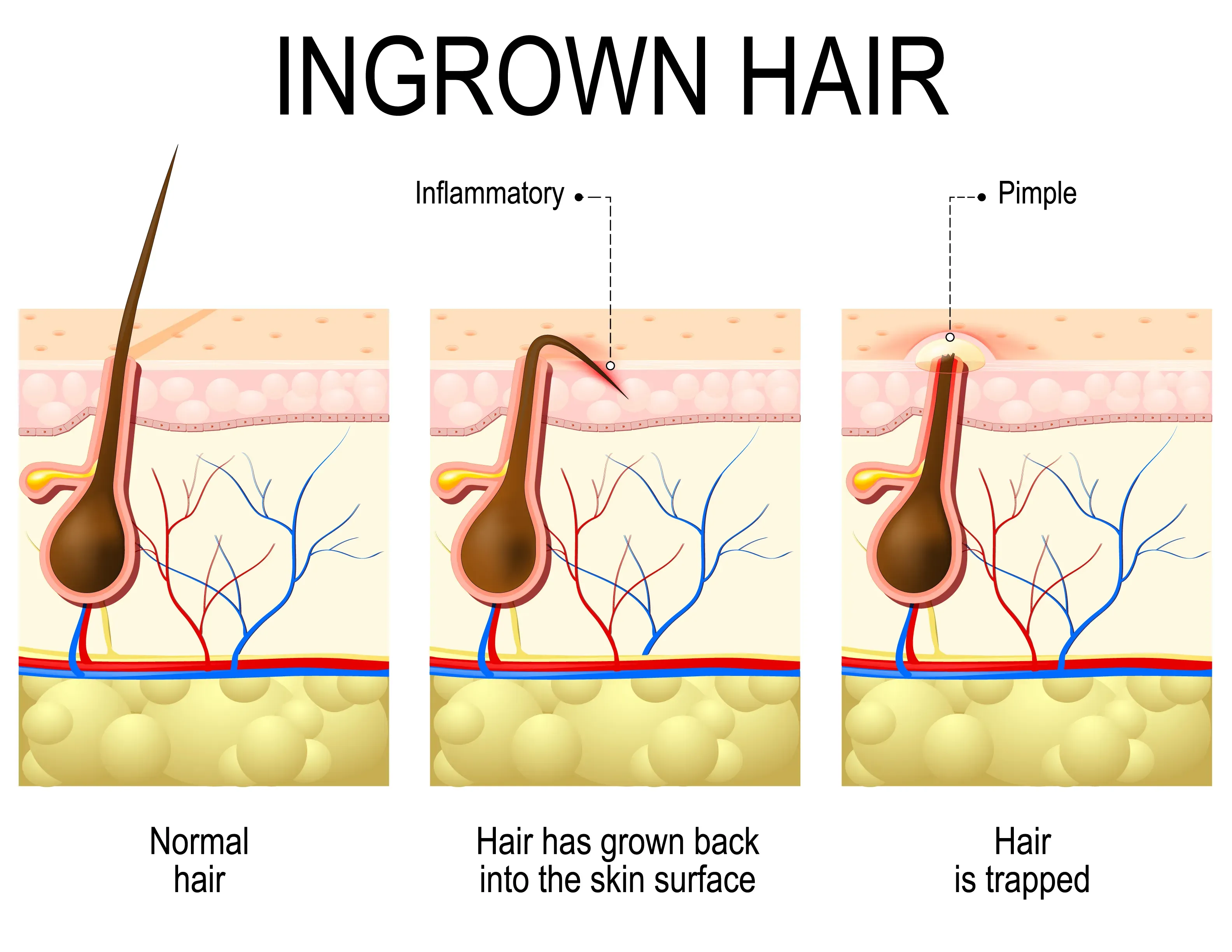 Unlock the secrets: how to remove ingrown hairs at home