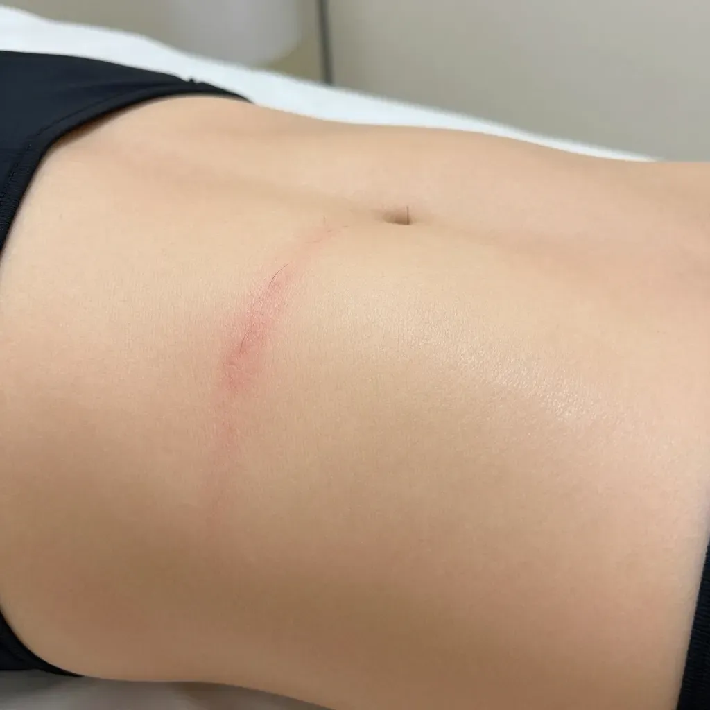 Ingrown Hair Removal Bikini Line