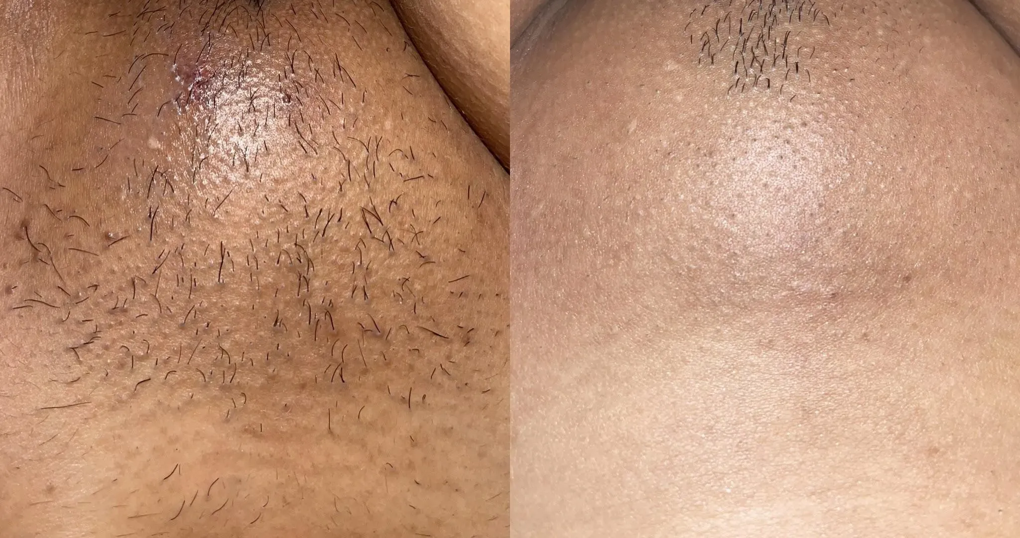 Is Brazilian Laser Hair Removal Right for You? Weighing the Reviews