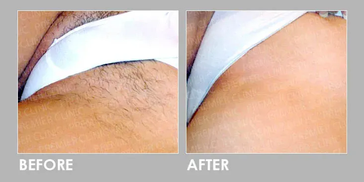 Is Full Brazilian Laser Hair Removal Worth the Investment?