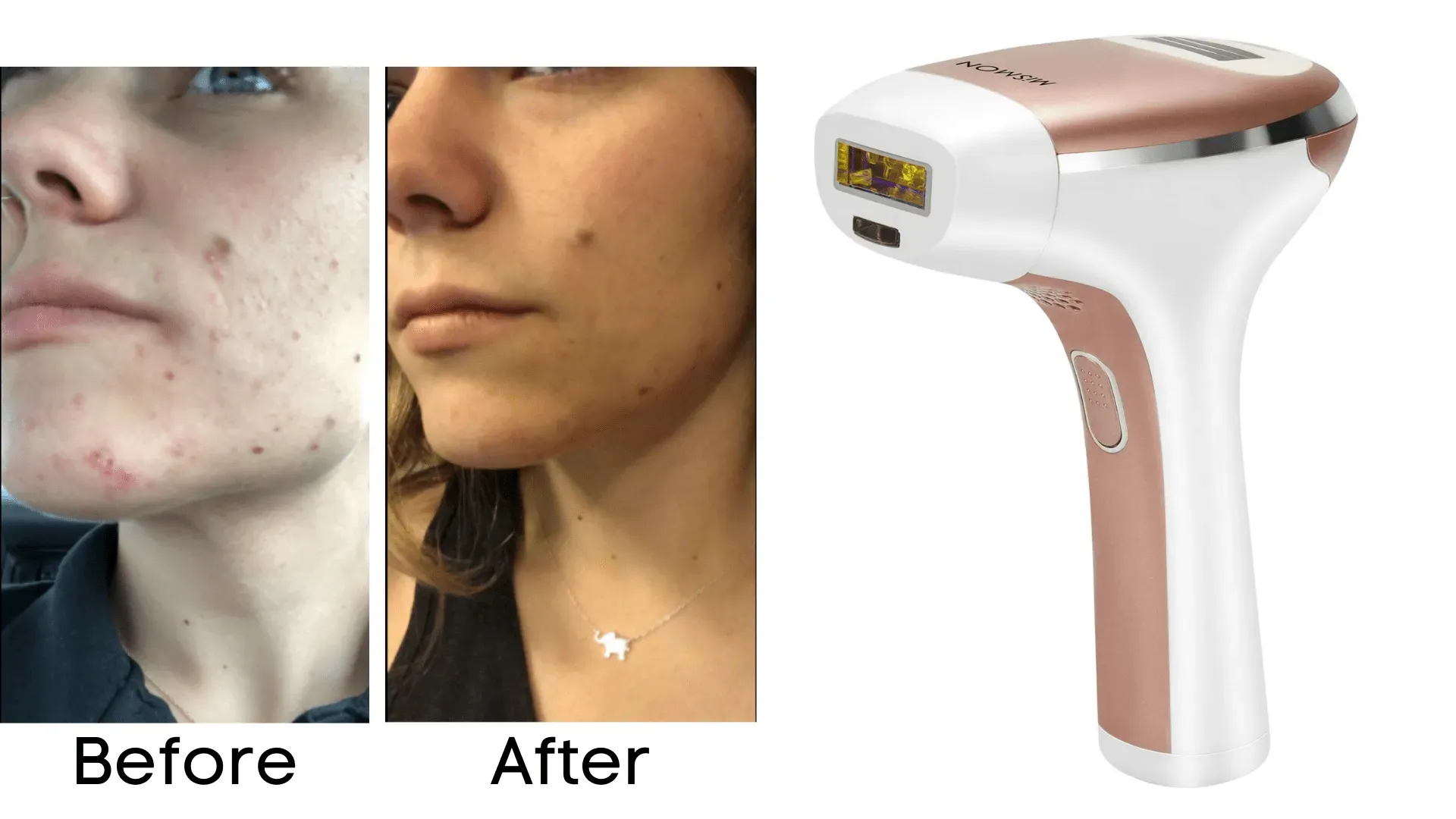 Key Factors in Choosing the Best Laser Hair Removal Clinic