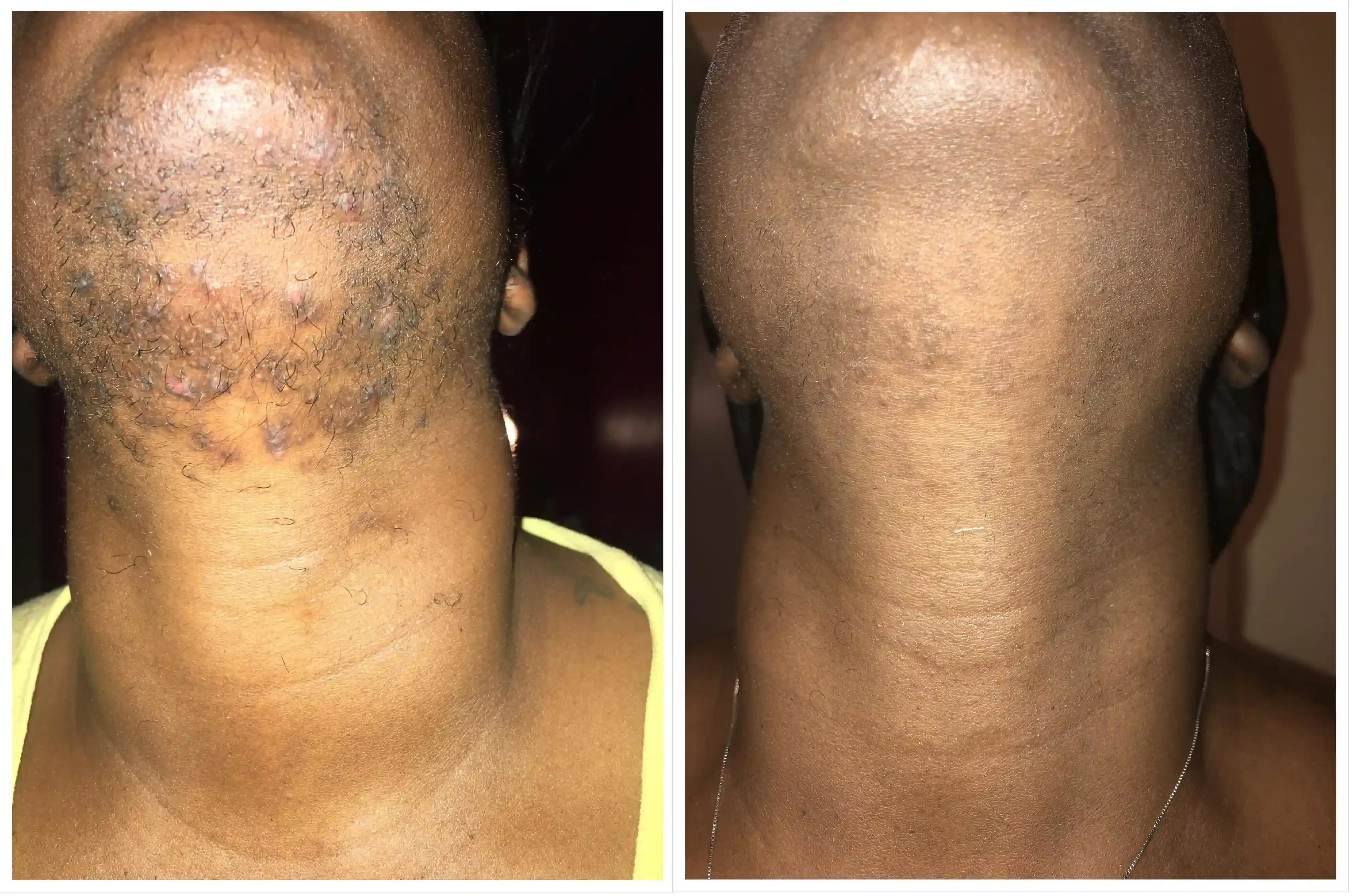Key Factors When Choosing Your Laser Hair Removal Spot