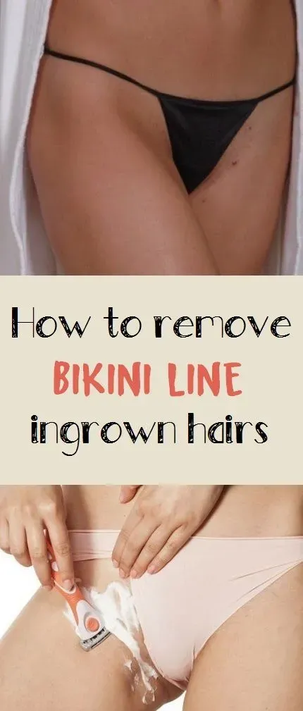 Preventing the Pests: Stopping Ingrown Bikini Hair Before It Starts