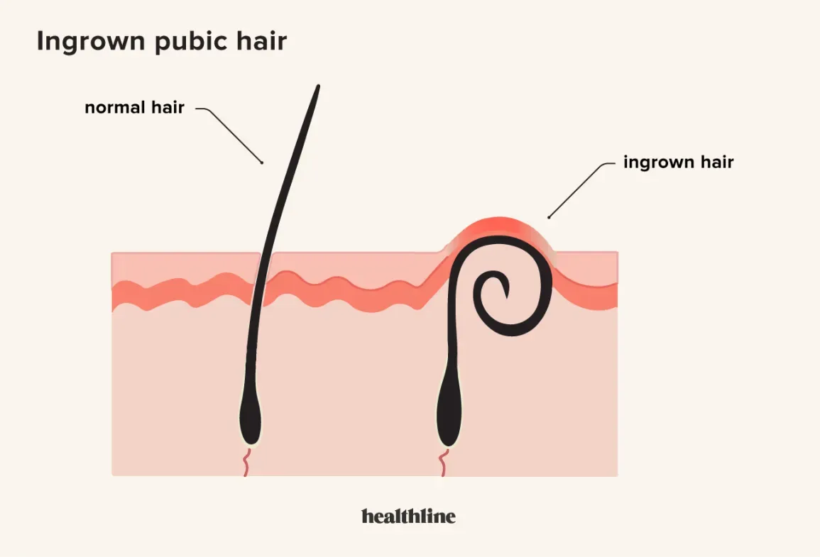 Prevention is Key: Stop Ingrown Hairs Before They Start