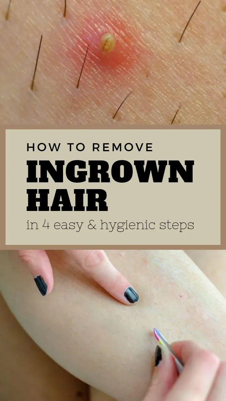 Safe and Simple Ways How to Remove Ingrown Hair at Home