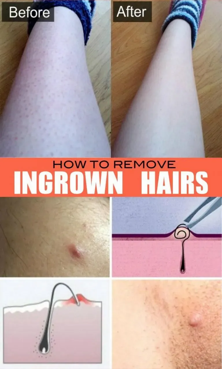 Safe Methods: How to Remove Ingrown Hair Under Skin at Home