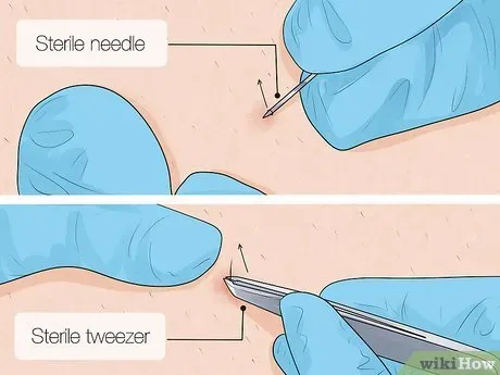 Stopping Ingrown Hairs Before They Start: Prevention Tips