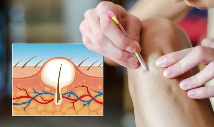 Stopping Ingrown Hairs Before They Start