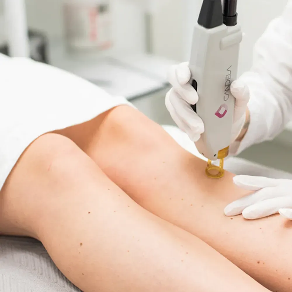 The Laser Hair Removal Process in Alpharetta: What to Expect