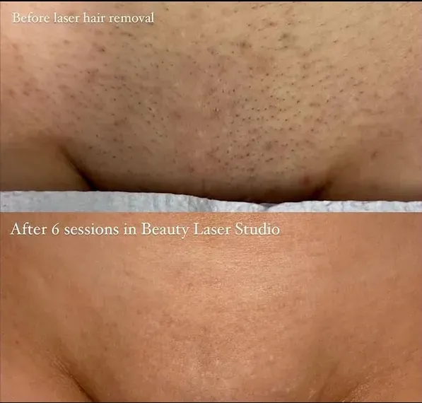 The Sensation: Is the Brazilian Laser Hair Removal First Session Painful?