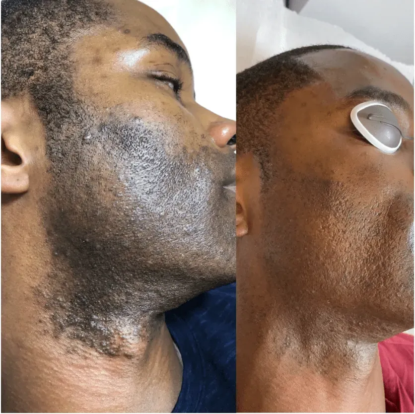 Tired of Bumps? Why See an Esthetician for Ingrown Hair Removal