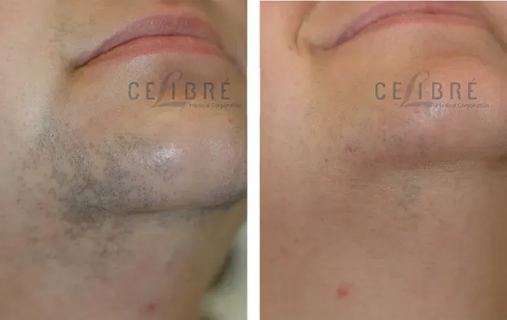 Top Picks: Evaluating the Best AtHome Laser for Facial Hair Removal