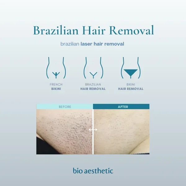 Typical Number of Sessions for Laser Hair Removal Brazilian
