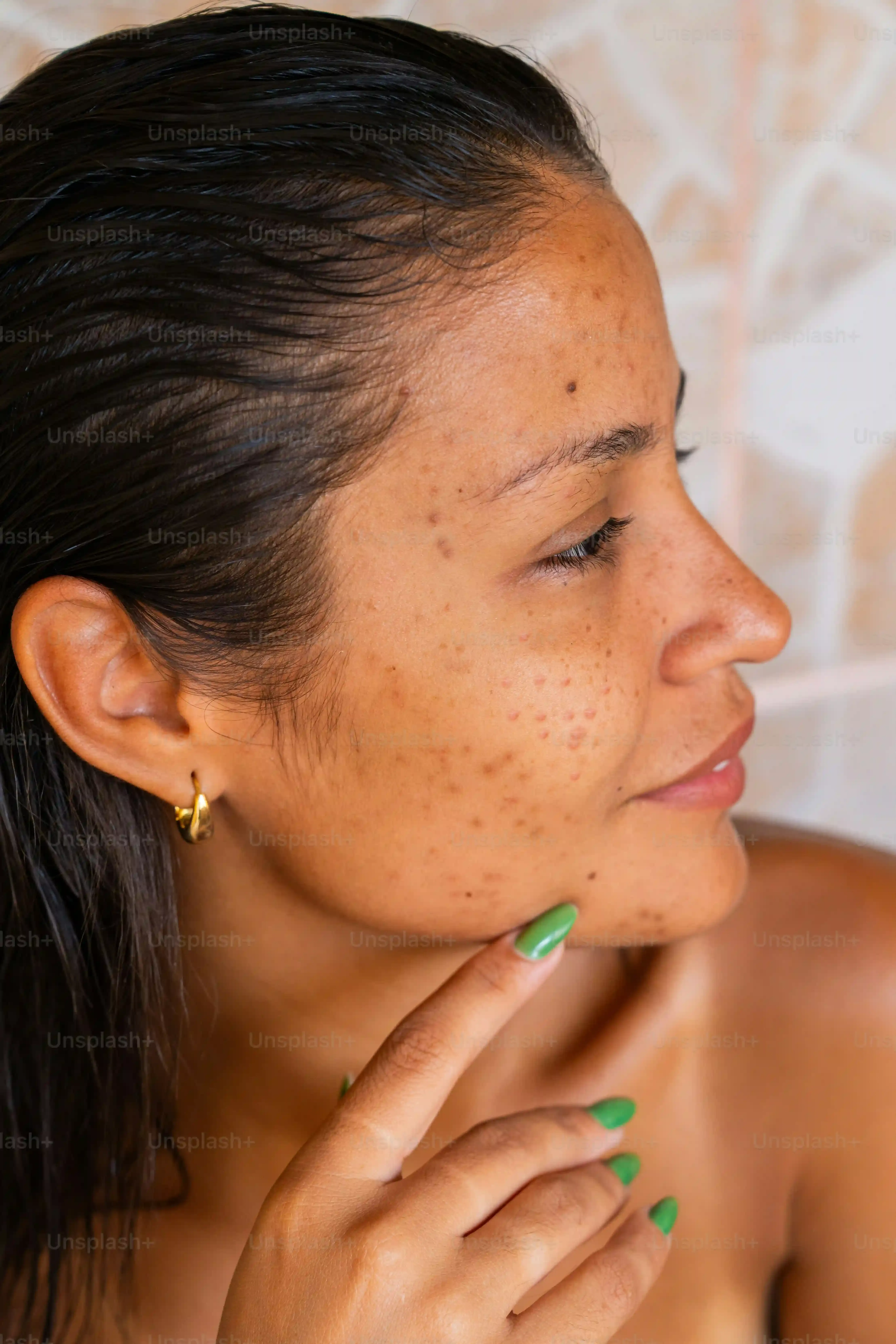 Understanding Brazilian Laser Hair Removal on Dark Skin