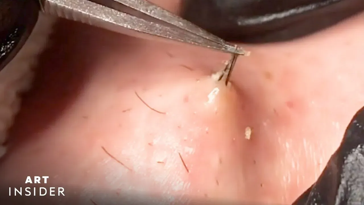 Understanding Extreme Ingrown Hair: More Than Just a Bump