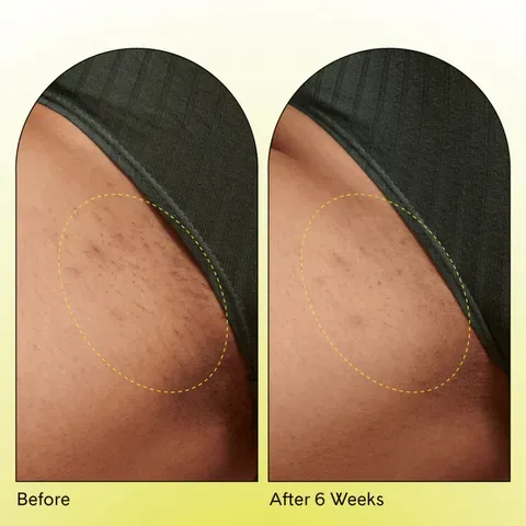 Understanding Ingrown Bikini Hair: Why It Happens Down There