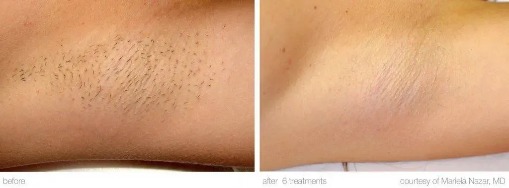 Understanding the Investment: Cost of Laser Hair Removal Los Angeles
