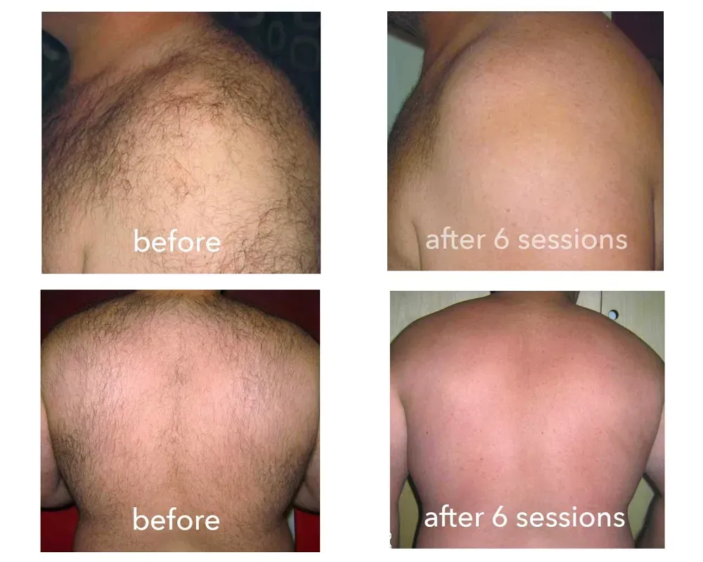 Weighing the Pros and Cons of Brazilian Laser Hair Removal