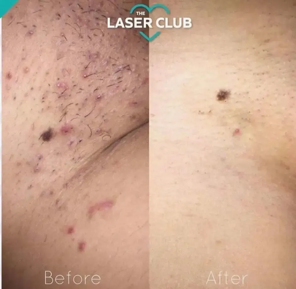What Exactly Are Ingrown Hairs and Why Do They Cause Trouble?