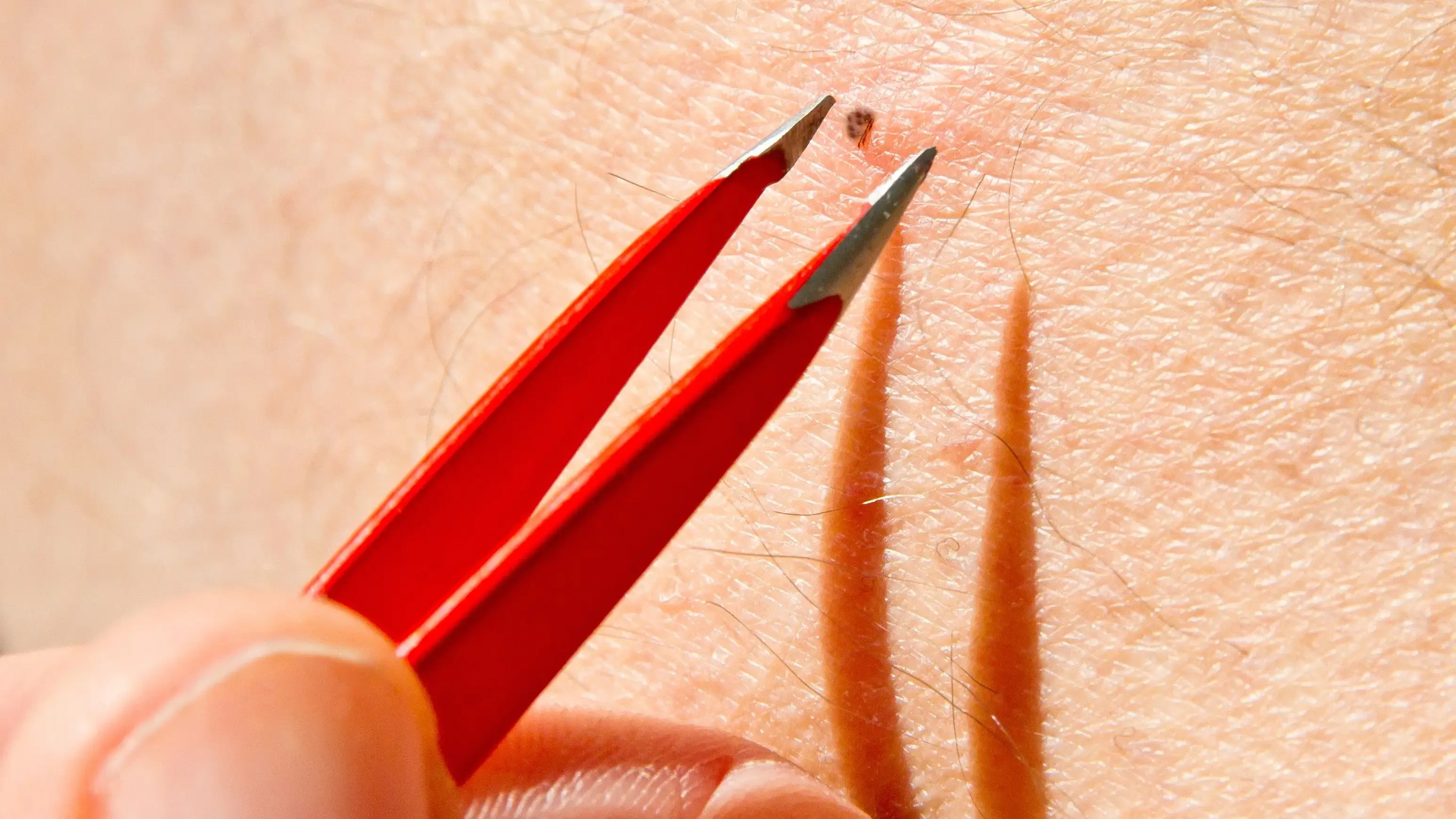 What Exactly Are Ingrown Hairs?