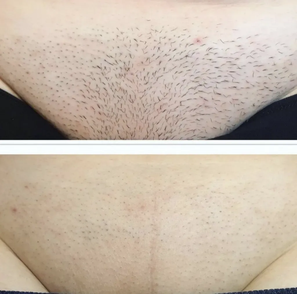 What Goes Down: Understanding Brazilian Laser Hair Removal