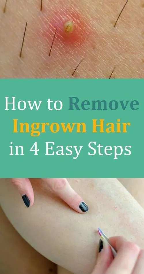 What Happens During Professional Ingrown Hair Removal?