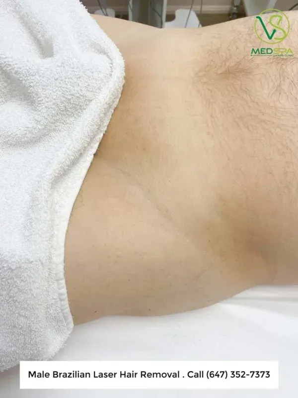 What Happens During Your Brazilian Laser Hair Removal Session