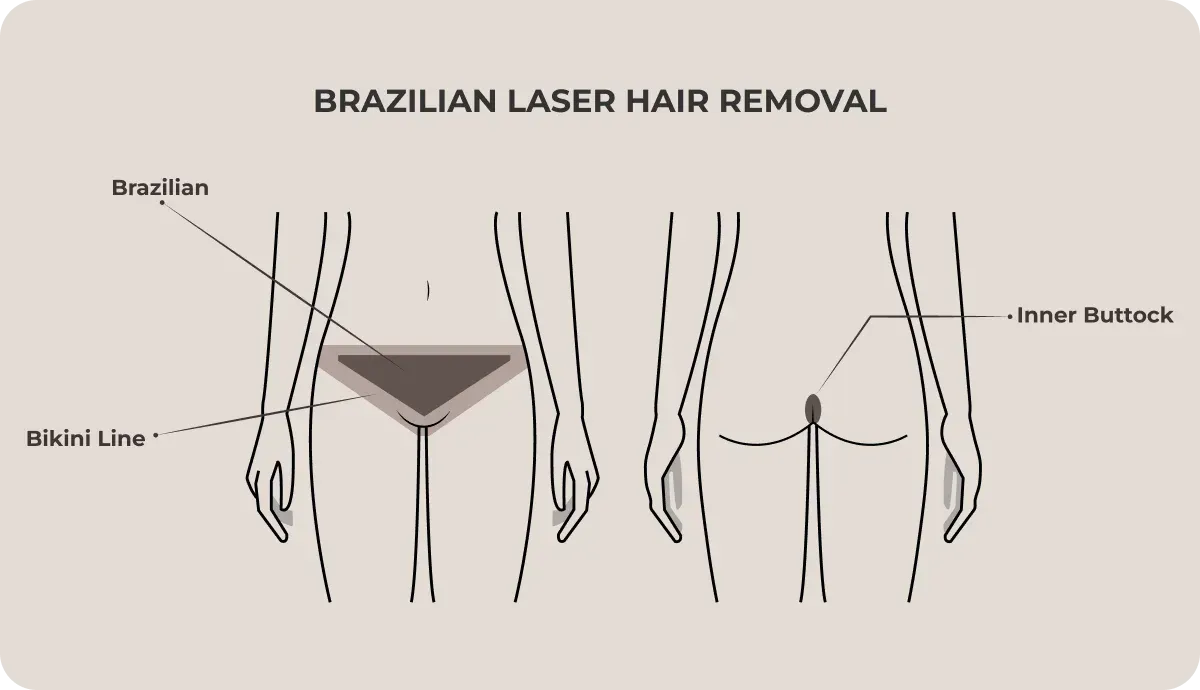 What Happens During Your Brazilian Laser Session?