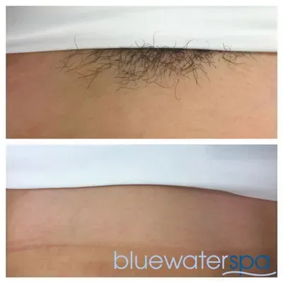 What Really Happens During Brazilian Laser Hair Removal?
