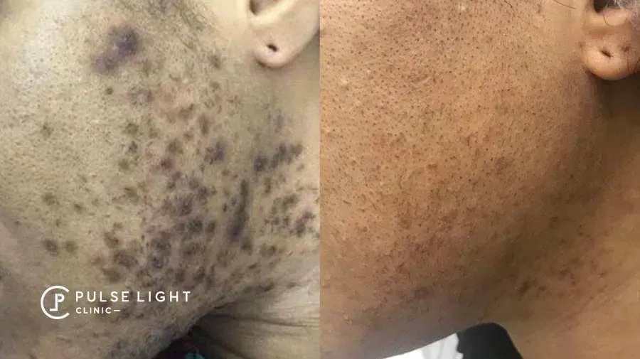 What to Expect from Your Facial Ingrown Hair Removal Near Me Session