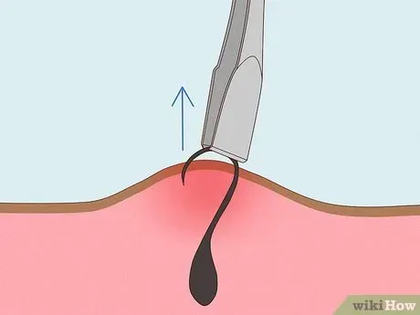 When Home Remedies Fail: Dealing with Stubborn Ingrown Hairs