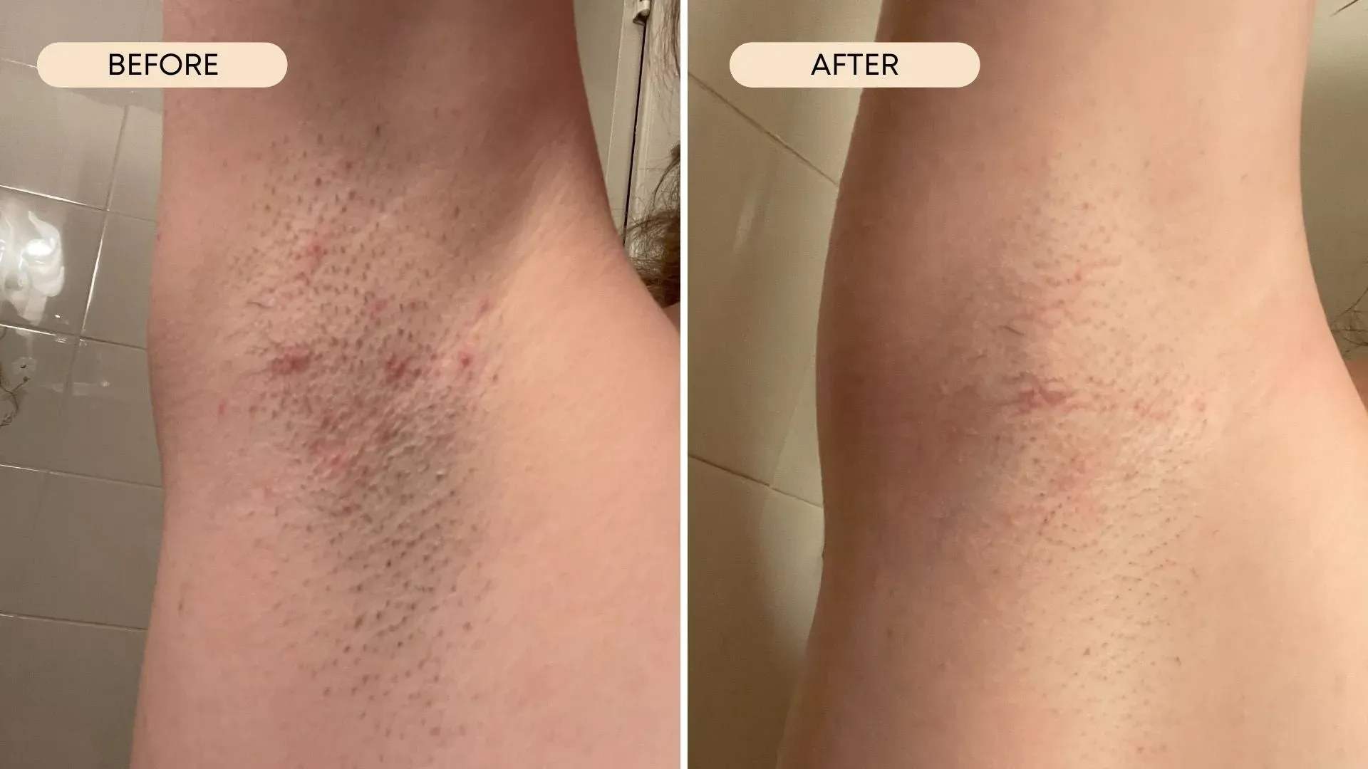 When to Get Help for Stubborn Ingrown Armpit Hair