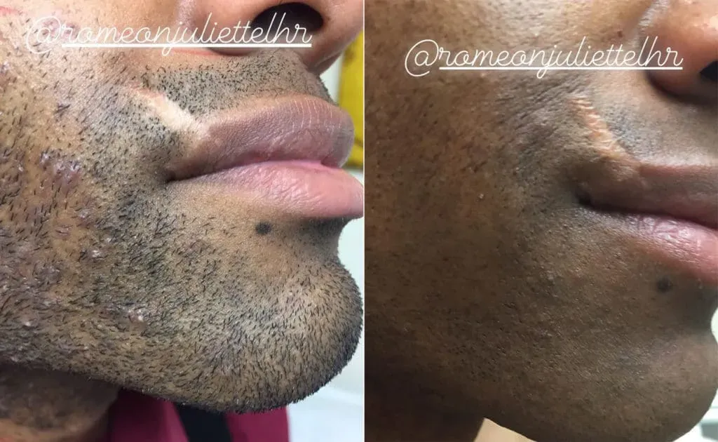 When to Seek Professional Help for Facial Ingrown Hair