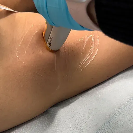 Why Brazilian Laser Hair Removal in Houston? Ditching the Razor Drama