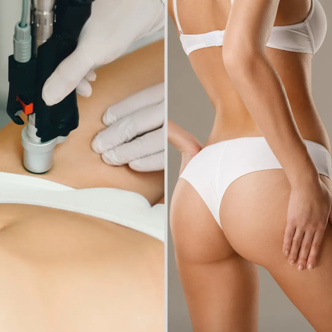 Why Brazilian Laser Hair Removal in New York? Ditching the Razor Hassle