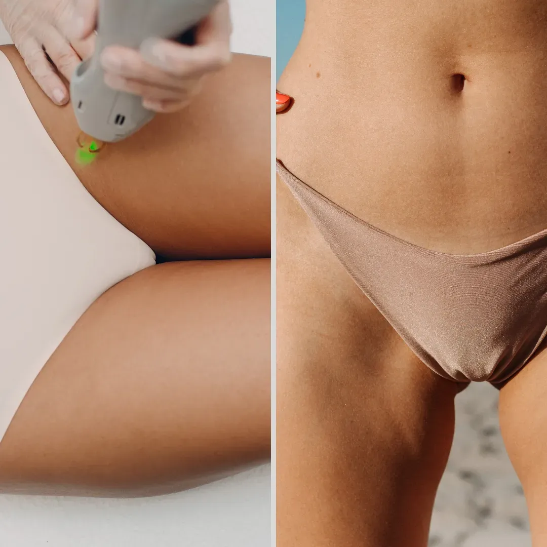 Why Consider Laser Hair Removal in NYC?