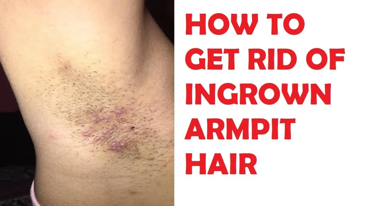 Why Ingrown Armpit Hair Happens (It's Not Just You)