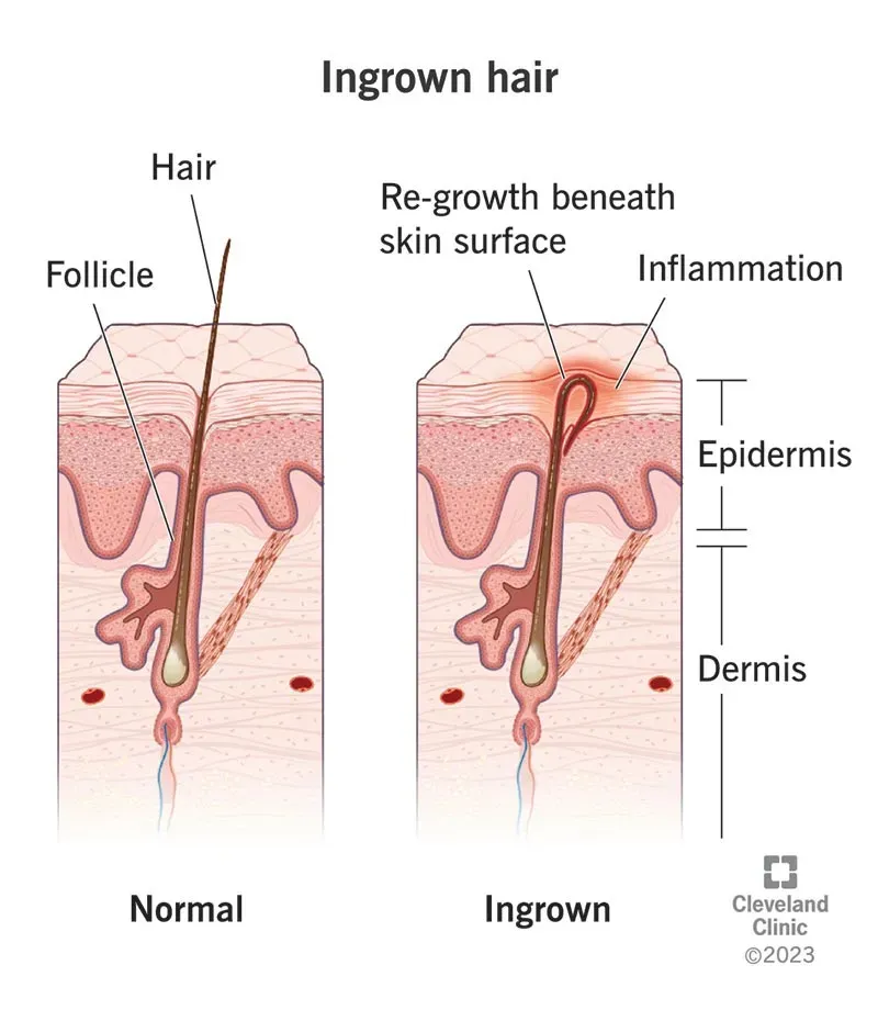 Why Ingrown Hairs Go Under the Skin