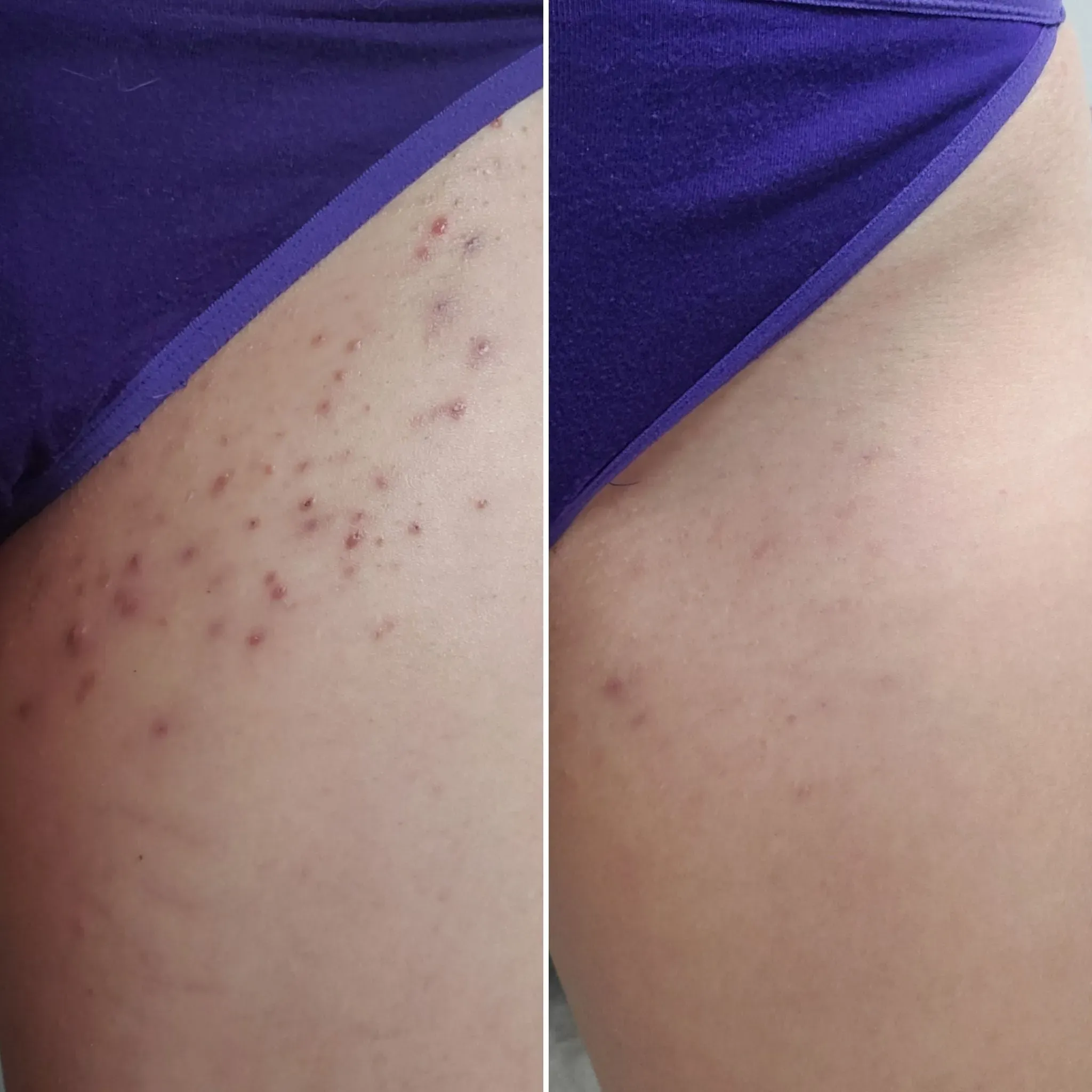 Why Ingrown Hairs Leave Scars (and How to Stop Them Early)