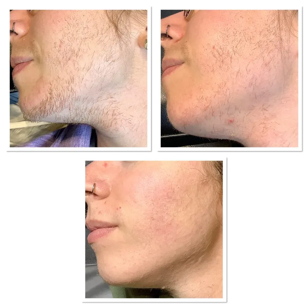 Why Most At Home Laser Hair Removal Won't Touch Red Hair