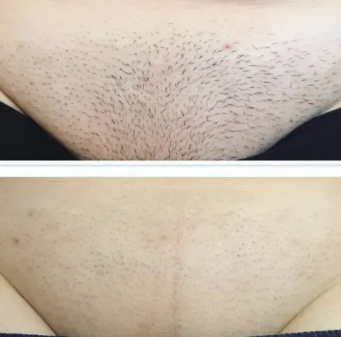 Why People Face Brazilian Laser Hair Removal Regret